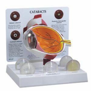 Cataract Eye Anatomical Set